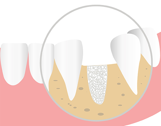 Implant dentaire